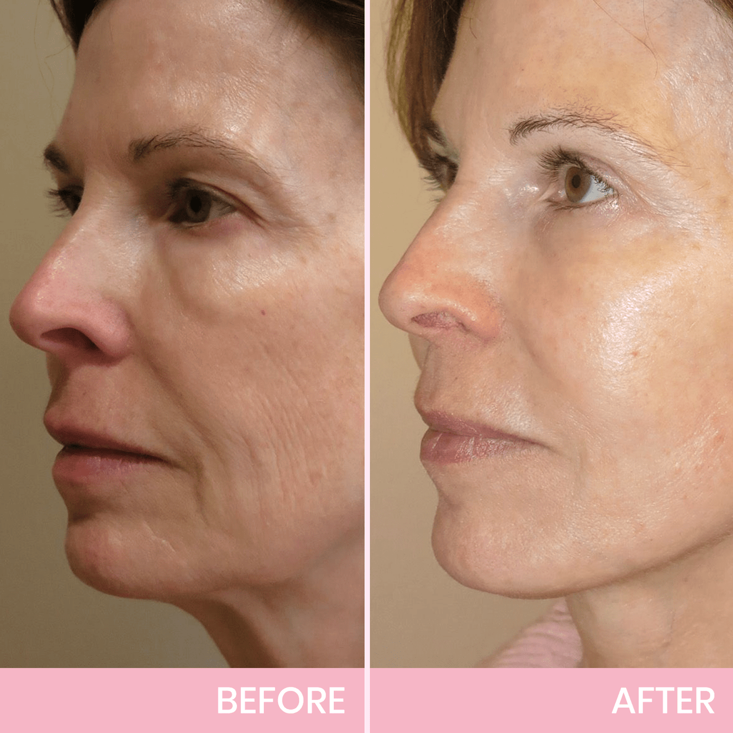 Luhaka™ V-Face Lifting Invisible Adhesive Tape 6