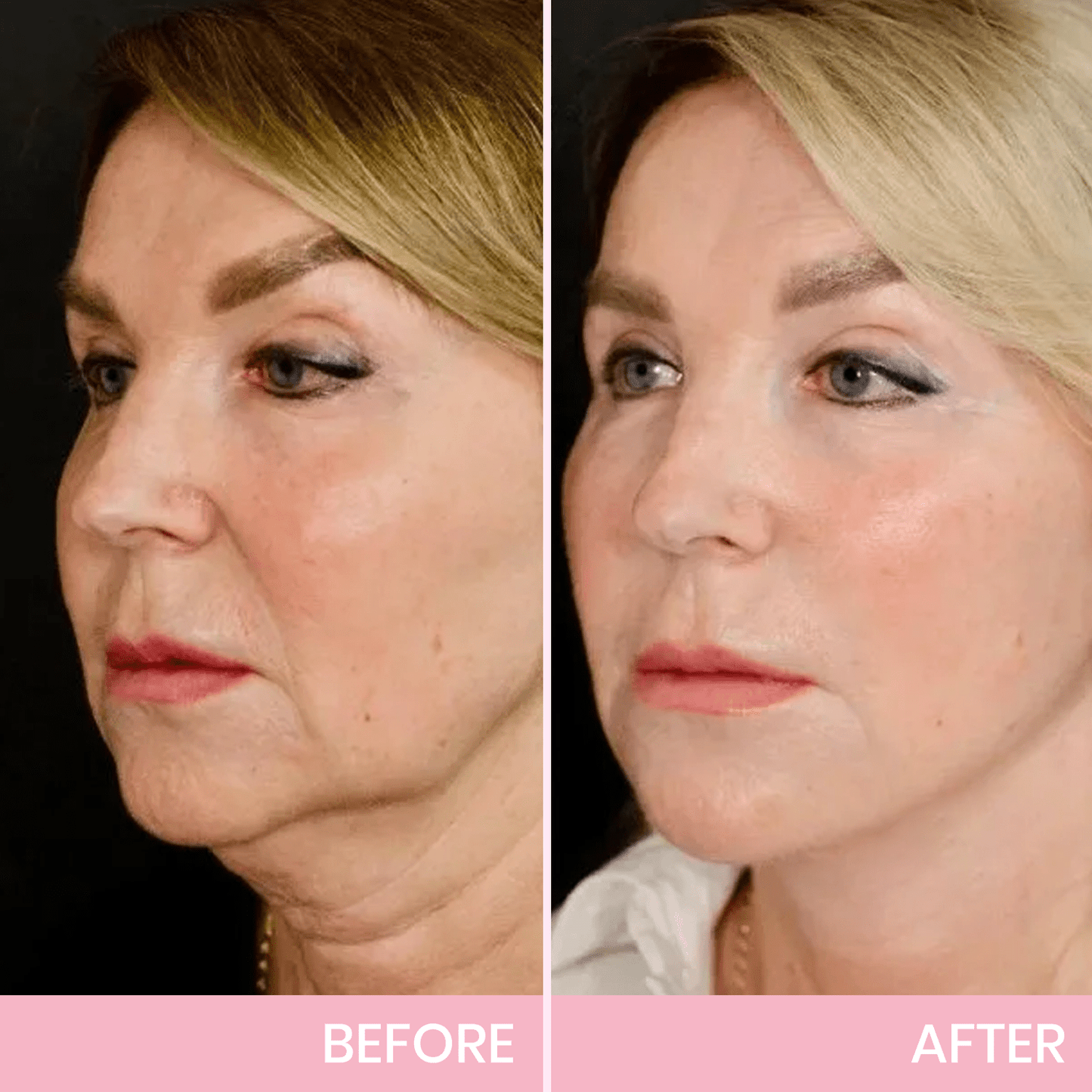 Luhaka™ V-Face Lifting Invisible Adhesive Tape 6